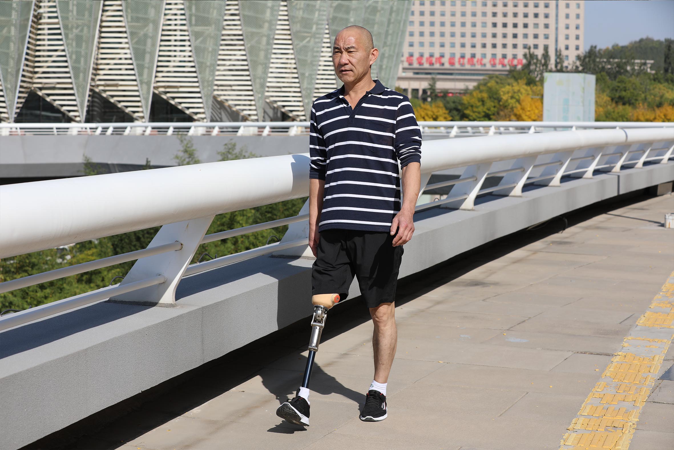 大腿假肢一般能用几年_优邦假肢矫形器上海有限公司_新浪博客